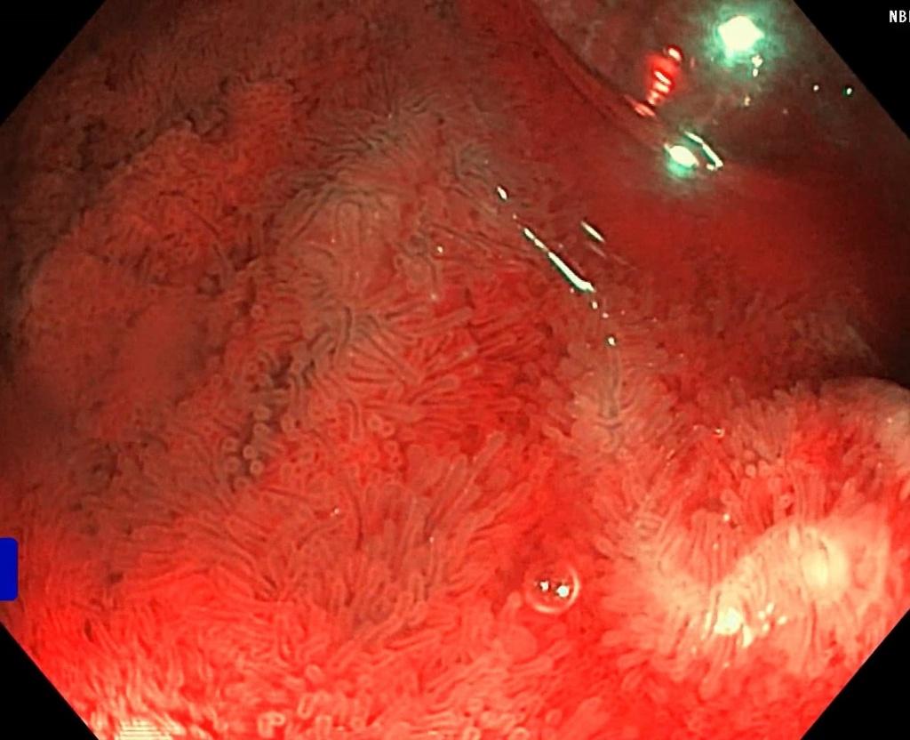 Рельеф слизистой оболочки подвздошной кишки (NBI, близкий фокус). Атлас эндоскопических изображений endoatlas